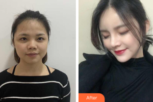 深圳蘭喬醫(yī)療美容門診部陳邦胤整形價格表附假體隆鼻墊下巴案例展示