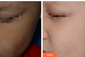 四川西嬋整形美容醫(yī)院何波整形價(jià)格表附激光祛斑案例展示