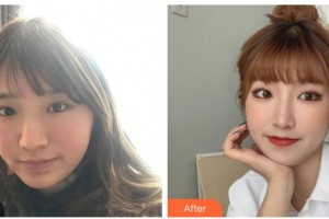 四川西嬋整形美容醫(yī)院許雙婷整形價(jià)格表附激光祛斑案例展示