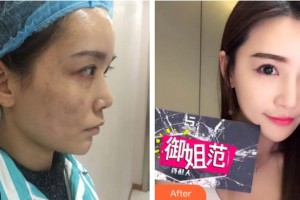 四川西嬋整形美容醫(yī)院曾占權(quán)整形價(jià)格表附激光祛斑案例展示