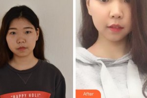 四川華美紫馨醫(yī)學(xué)美容醫(yī)院劉建民整形價(jià)格表附激光祛斑案例展示