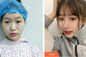 四川軍大醫(yī)學(xué)研究所附屬醫(yī)院美容整形科張作香整形價(jià)格表附鼻部綜合案例展示