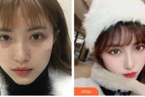 四川西嬋泛亞醫(yī)學(xué)美容醫(yī)院馮中和整形價(jià)格表附熱瑪吉案例展示