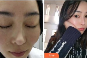 四川西嬋泛亞醫(yī)學(xué)美容醫(yī)院丁艷整形價(jià)格表附激光祛斑案例展示