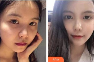 四川西嬋泛亞醫(yī)學(xué)美容醫(yī)院陳麗麗整形價(jià)格表附熱瑪吉案例展示