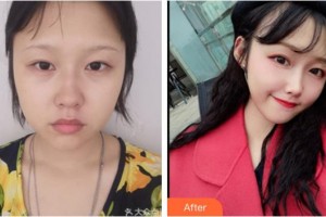 四川西嬋泛亞醫(yī)學(xué)美容醫(yī)院張蕾整形價(jià)格表附埋線提升案例展示