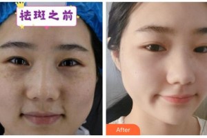 自貢市第四人民醫(yī)院整形美容科朱必清整形價(jià)格表附激光祛斑案例展示