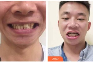 自貢維樂新橋口腔門診部米蓉整形價(jià)格表附牙齒隱形矯正案例展示