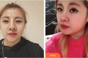 攀枝花市中心醫(yī)院燒傷整形美容科張蕊整形價(jià)格表附熱瑪吉案例展示