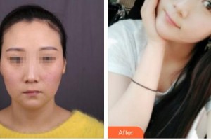 攀枝花中韓卓美博大醫(yī)院醫(yī)療美容科楊洪英整形價(jià)格表附埋線提升案例展示