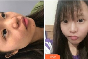 瀘州醫(yī)學院附屬醫(yī)院整形燒傷科郭力整形價格表附手術祛疤案例展示