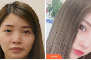 瀘州醫(yī)學院附屬醫(yī)院整形燒傷科何小川整形價格表附鼻部綜合例展示