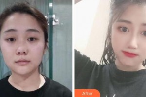 瀘州醫(yī)學院附屬醫(yī)院整形燒傷科李越鋼整形價格表附肋軟骨隆鼻案例展示