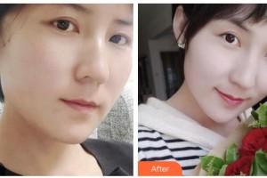 瀘州美馨醫(yī)學整形美容診所方峰整形價格表附埋線提升案例展示