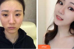 深圳美客華美醫(yī)療美容門診部陶宏偉整形價格表附面部吸脂案例展示