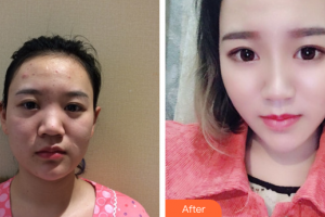 深圳美客華美醫(yī)療美容門診部王力佳整形價(jià)格表附清潔祛痘案例展示