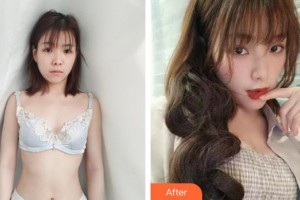 瀘州碧特牙科醫(yī)院孫寶東整形價格表附自體脂肪隆胸案例展示