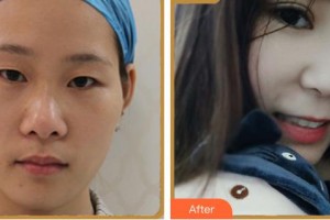 瀘州愛瑞眼科醫(yī)院胡海燕整形價格表附眼部綜合案例展示