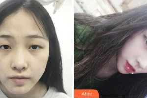 瀘州碧特牙科醫(yī)院王沐釷整形價格表附雙眼皮案例展示