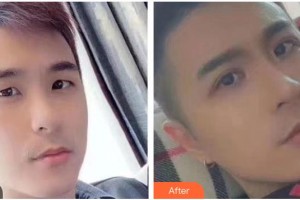 瀘州愛瑞眼科醫(yī)院張可杰整形價格表附眼部綜合案例展示