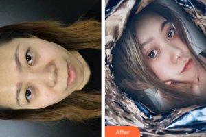 深圳瑞光醫(yī)療美容門診部蔣亦整形價格表附切開雙眼皮案例展示