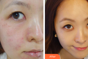 深圳瑞光醫(yī)療美容門診部陳亞軍整形價格表附果酸煥膚案例展示