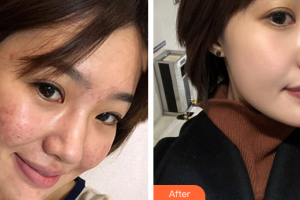 深圳軍科整形美容醫(yī)院劉金鳳整形價格表附痘坑痘印改良案例展示