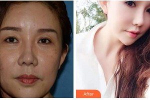 瀘州愛爾眼科醫(yī)院胡明江整形價格表附外切祛眼袋案例展示