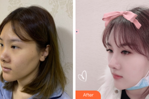 深圳微姿醫(yī)療美容門診部康壯為整形價格表附肋軟骨鼻部手術(shù)案例展示