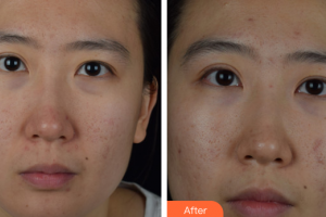 深圳廣濟(jì)門診部醫(yī)療美容科周鵬武整形價格表附去痘印痘坑案例展示