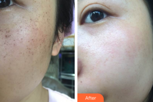 深圳福華中西醫(yī)結(jié)合醫(yī)院醫(yī)學(xué)美容科李碧容整形價格表附超激光美膚+祛斑針案例展示