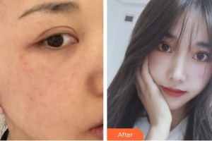 德陽市人民醫(yī)院燒傷整形科李云飛整形價格表附激光美膚激光案例展示