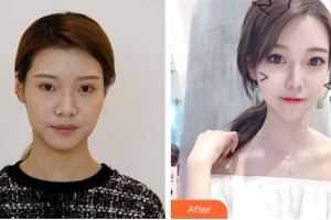 德陽市人民醫(yī)院燒傷整形科陳莉整形價格表附埋線提升案例展示