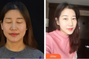 德陽金榮醫(yī)療美容?？漆t(yī)院沈軍國整形價格表附熱瑪吉案例展示