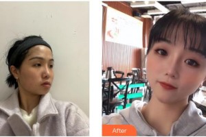 德陽金榮醫(yī)療美容?？漆t(yī)院吳沙冰整形價格表附埋線提升案例展示