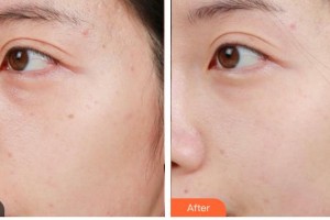 德陽金榮醫(yī)療美容?？漆t(yī)院尹靜整形價格表附激光美膚激光案例展示