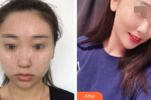 深圳和協(xié)門診部整形美容科劉開山整形價格表附去痘印痘坑案例展示