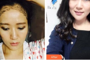 德陽(yáng)德美醫(yī)療美容門診部于洲戡整形價(jià)格表附種植發(fā)際線案例展示