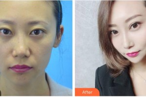 德陽(yáng)德美醫(yī)療美容門診部張莉整形價(jià)格表附埋線提升案例展示