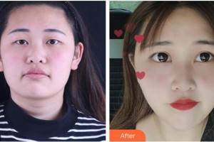 德陽(yáng)市口腔醫(yī)院整形美容科劉鳳瓊整形價(jià)格表附眼部綜合案例展示