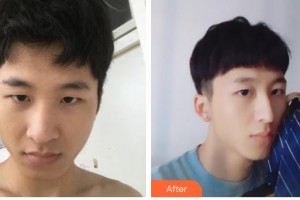 德陽(yáng)東美醫(yī)療美容整形門診部鐘正強(qiáng)整形價(jià)格表附鼻部綜合案例展示