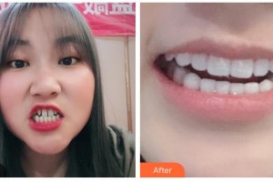 德陽(yáng)維樂新橋口腔門診部趙丹整形價(jià)格表附牙貼面案例展示