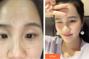 深圳新興皮膚病?？崎T診部方梅君整形價格表附祛雀斑案例展示