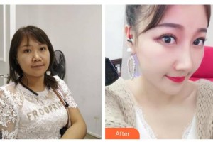 綿陽(yáng)煌佳醫(yī)學(xué)美容診所李忠永整形價(jià)格表附鼻中隔軟骨隆鼻案例展示