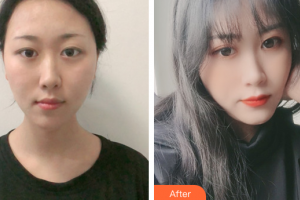 深圳星顏醫(yī)療美容醫(yī)院朱和清整形價格表附超激光美膚綜合案例展示