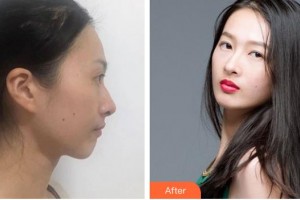 綿陽(yáng)第三人民醫(yī)院醫(yī)療美容科廖小川整形價(jià)格表附鼻部綜合案例展示