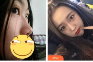 綿陽(yáng)協(xié)和醫(yī)院醫(yī)學(xué)美容中心孟春麗整形價(jià)格表附肋軟骨隆鼻案例展示