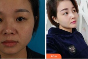 綿陽(yáng)整形美容醫(yī)院趙波整形價(jià)格表附耳軟骨復(fù)合隆鼻案例展示