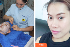 深圳美雅童顏醫(yī)療美容醫(yī)院張海晏整形價格表附黃金微針案例展示