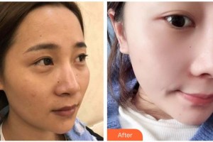 綿陽(yáng)中心醫(yī)院醫(yī)學(xué)美容科周竹梅整形價(jià)格表附鼻部綜合案例展示